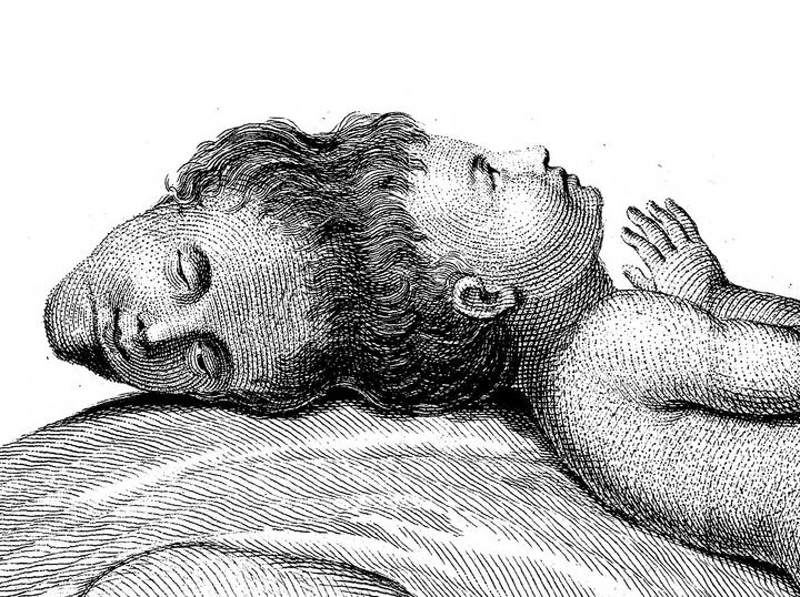 The Extraordinary Tale of a Head Born Without a Body